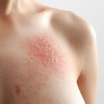 Rote Brust: Ursachen, Symptome und wann Sie zum Arzt sollten